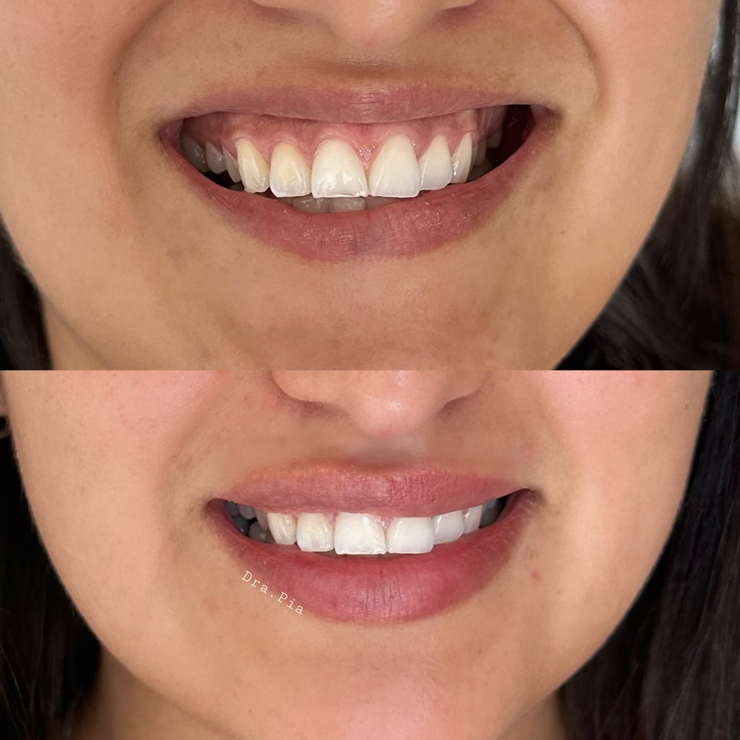 Corrección de Sonrisa Gingival con neuromodulador