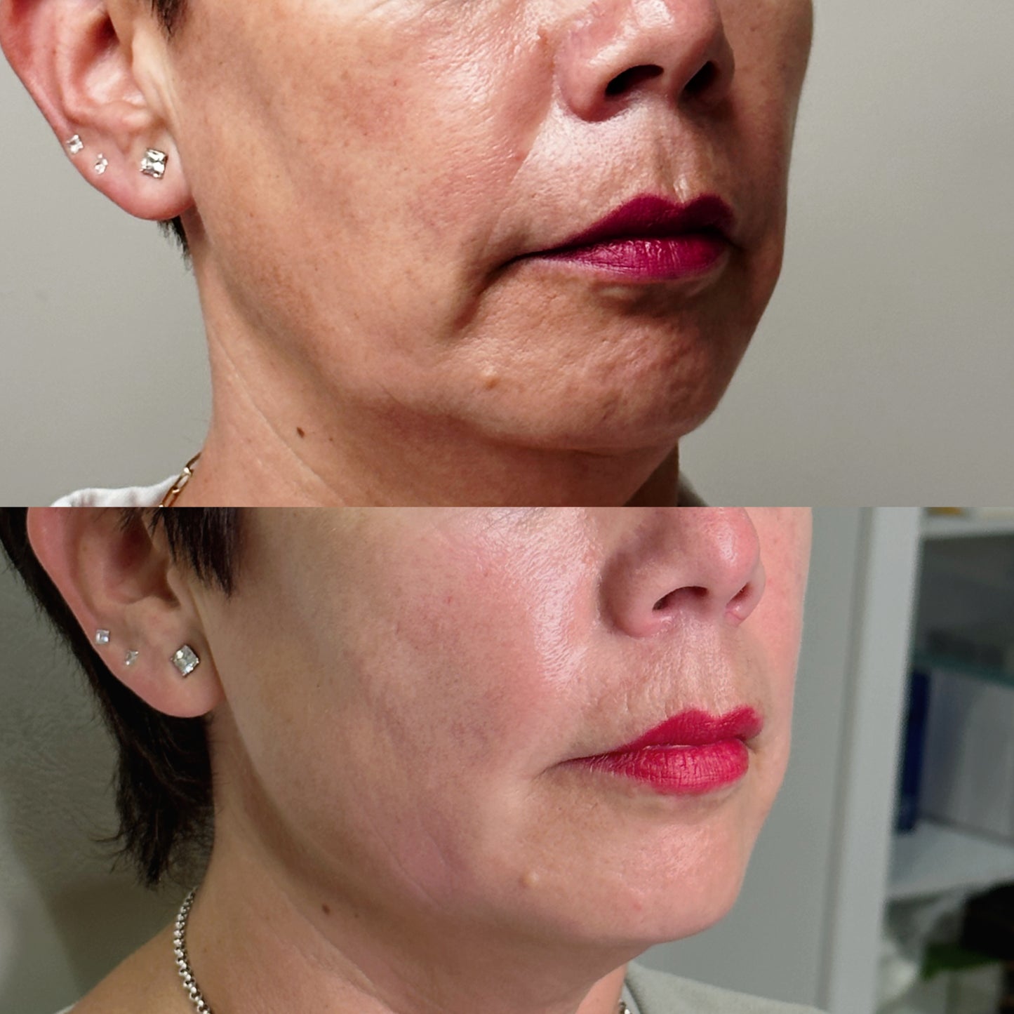 Sculptra® – Bioestimulación Avanzada de Colágeno