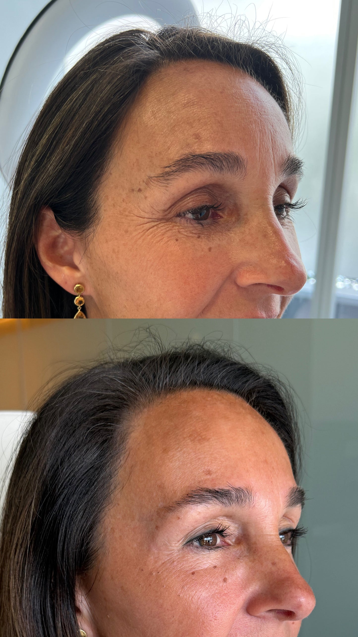 Resurfacing con Láser CO2 Tetra Pro