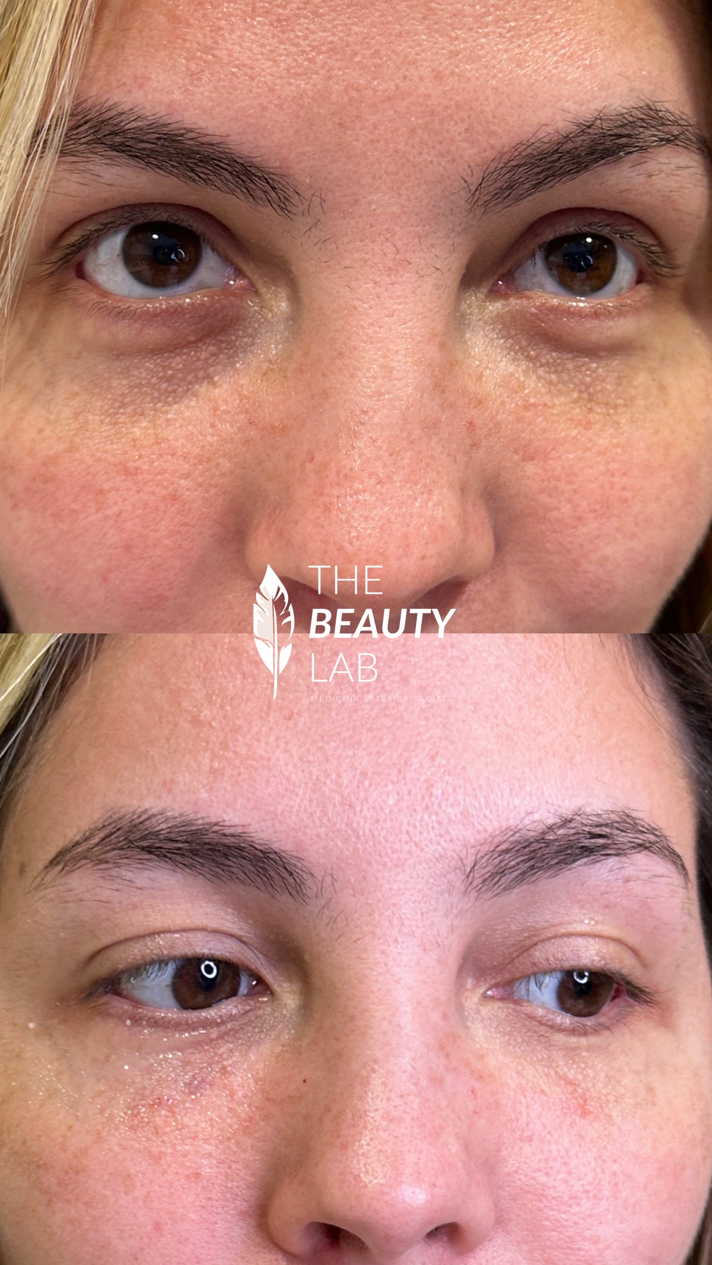 Aumento y definición de pómulos