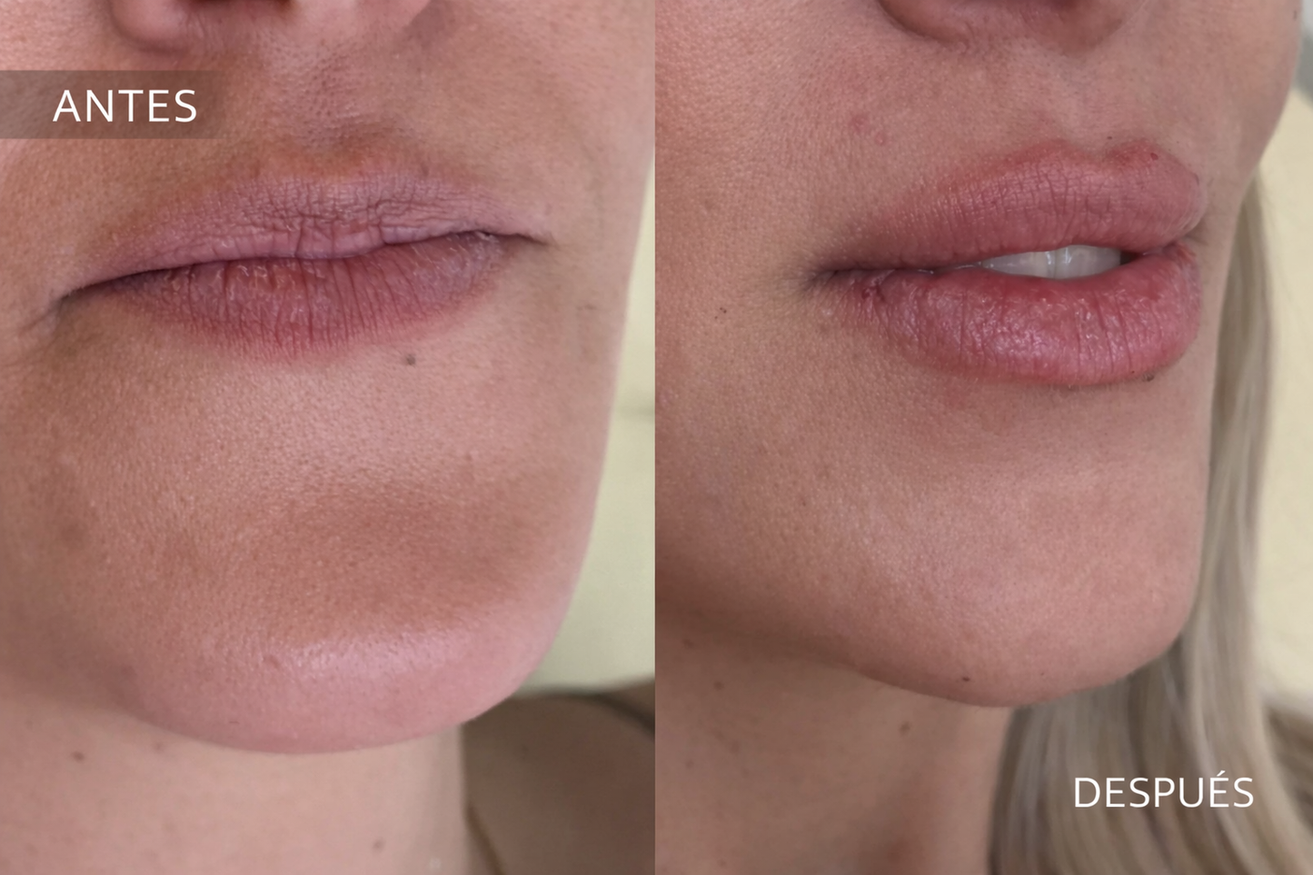 Labios lips by Dra Pia