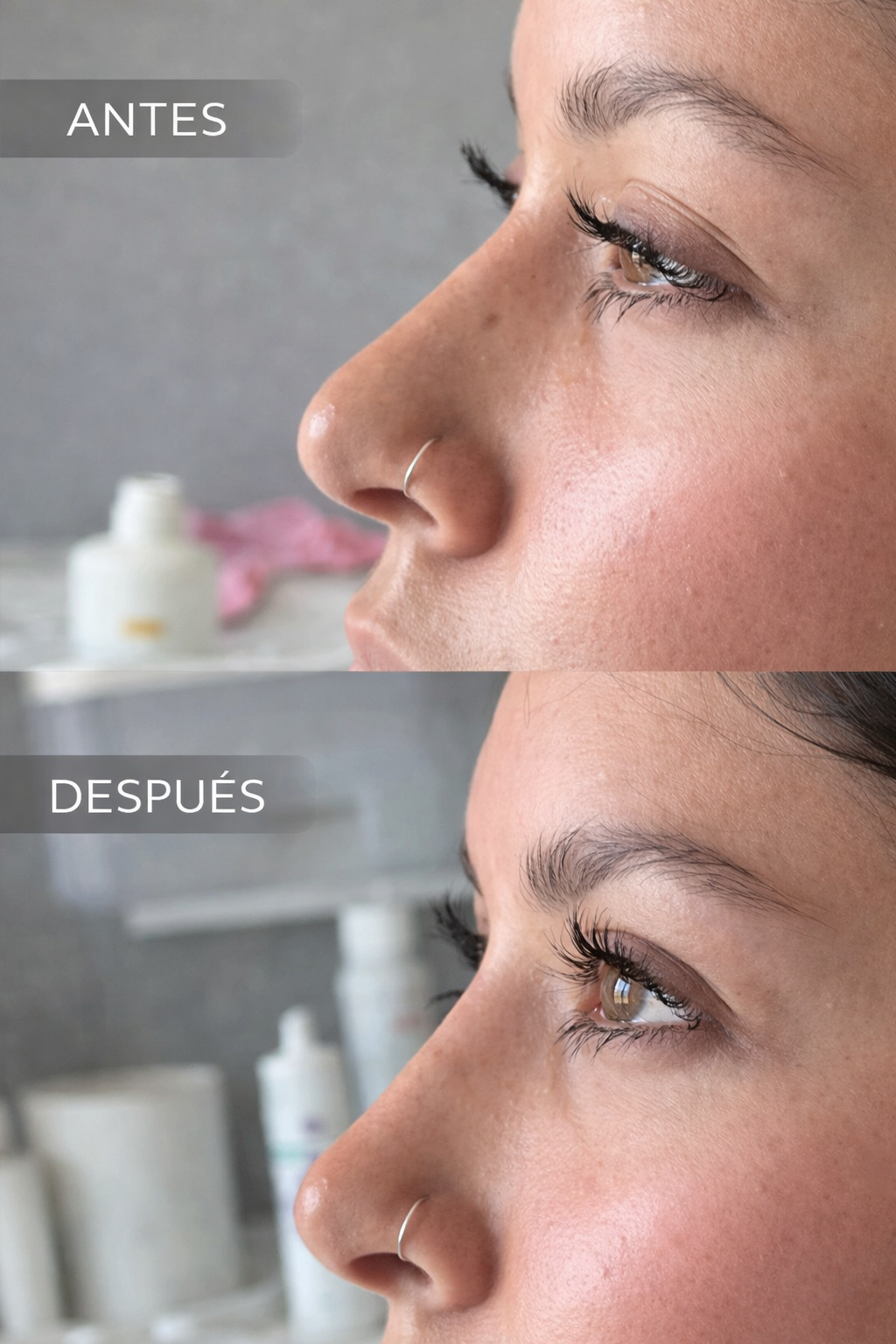 Rinomodelación Sin Cirugía