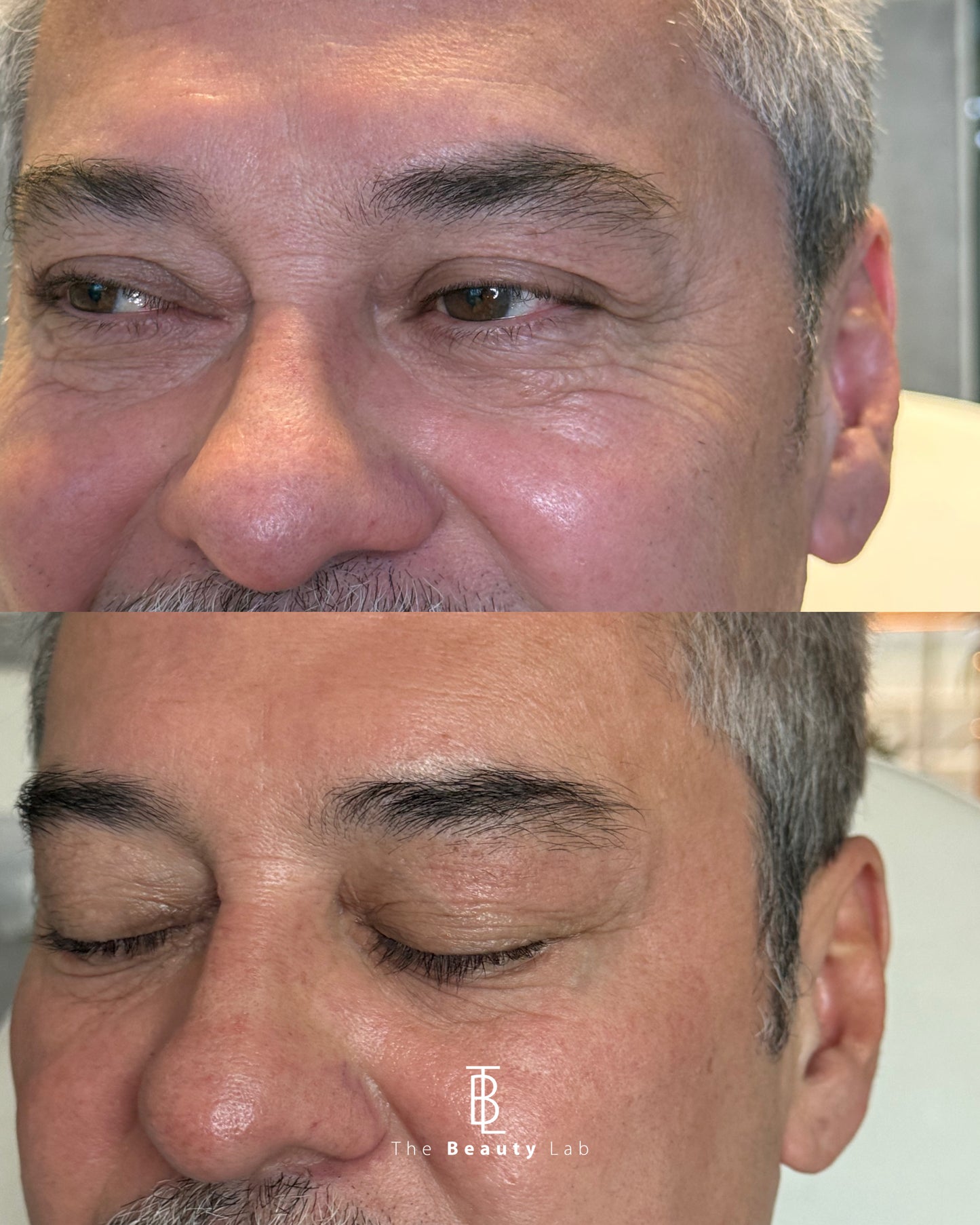 Rejuvenecimiento Periocular con Láser CO2 Tetra Pro de Deka (Italia)