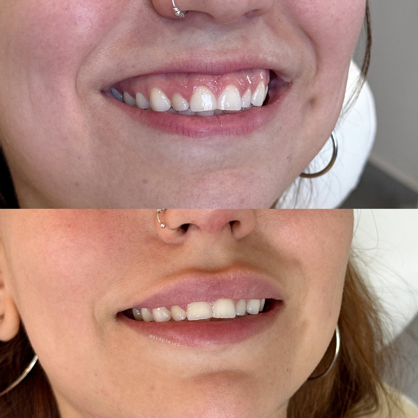 Lip Flip – Definición natural del labio superior con Toxina Botulínica