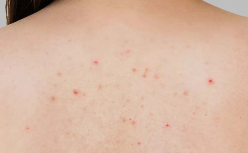 Acne Back & Chest Treatment Spray