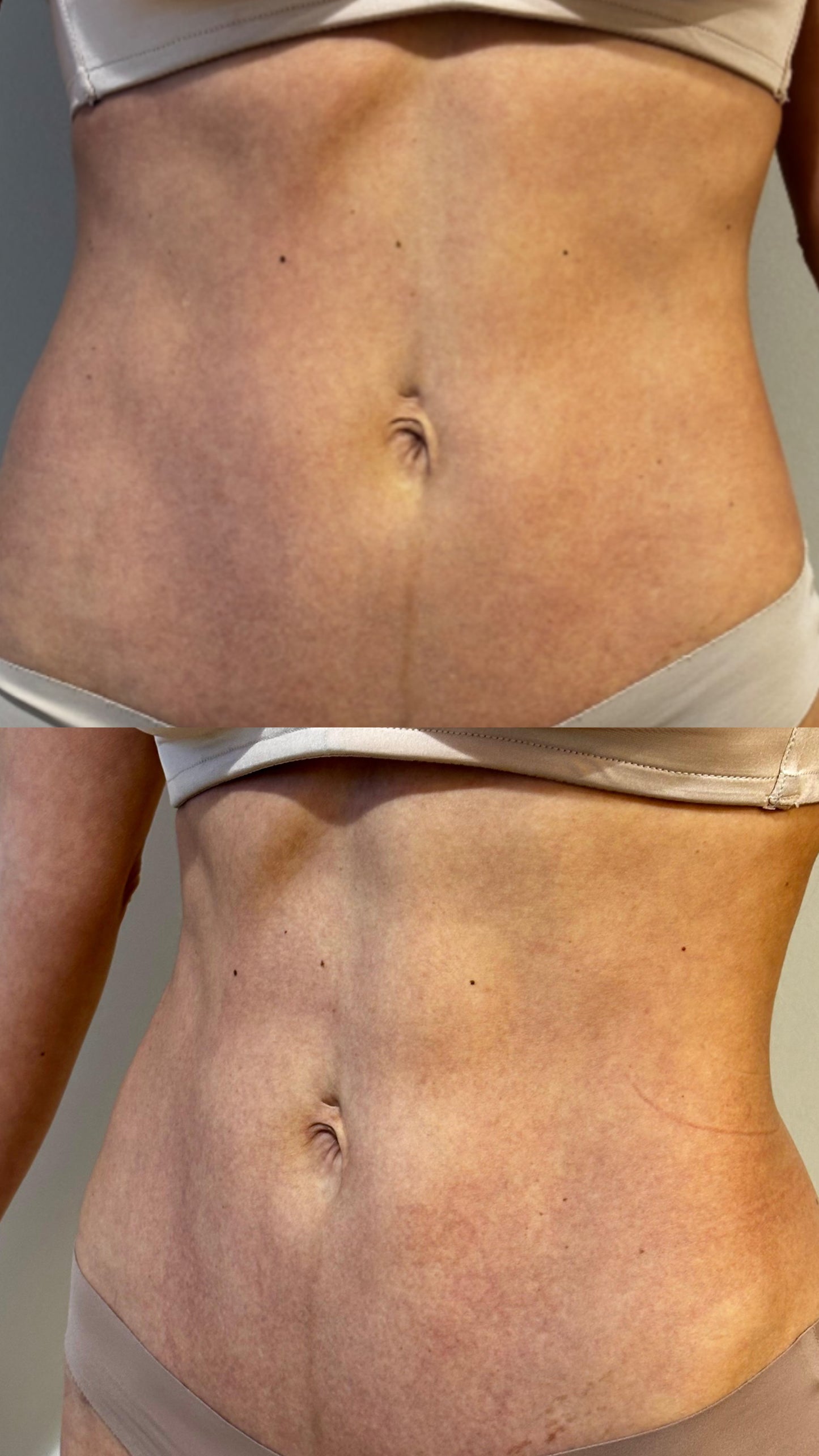 Post parto - Abdomen