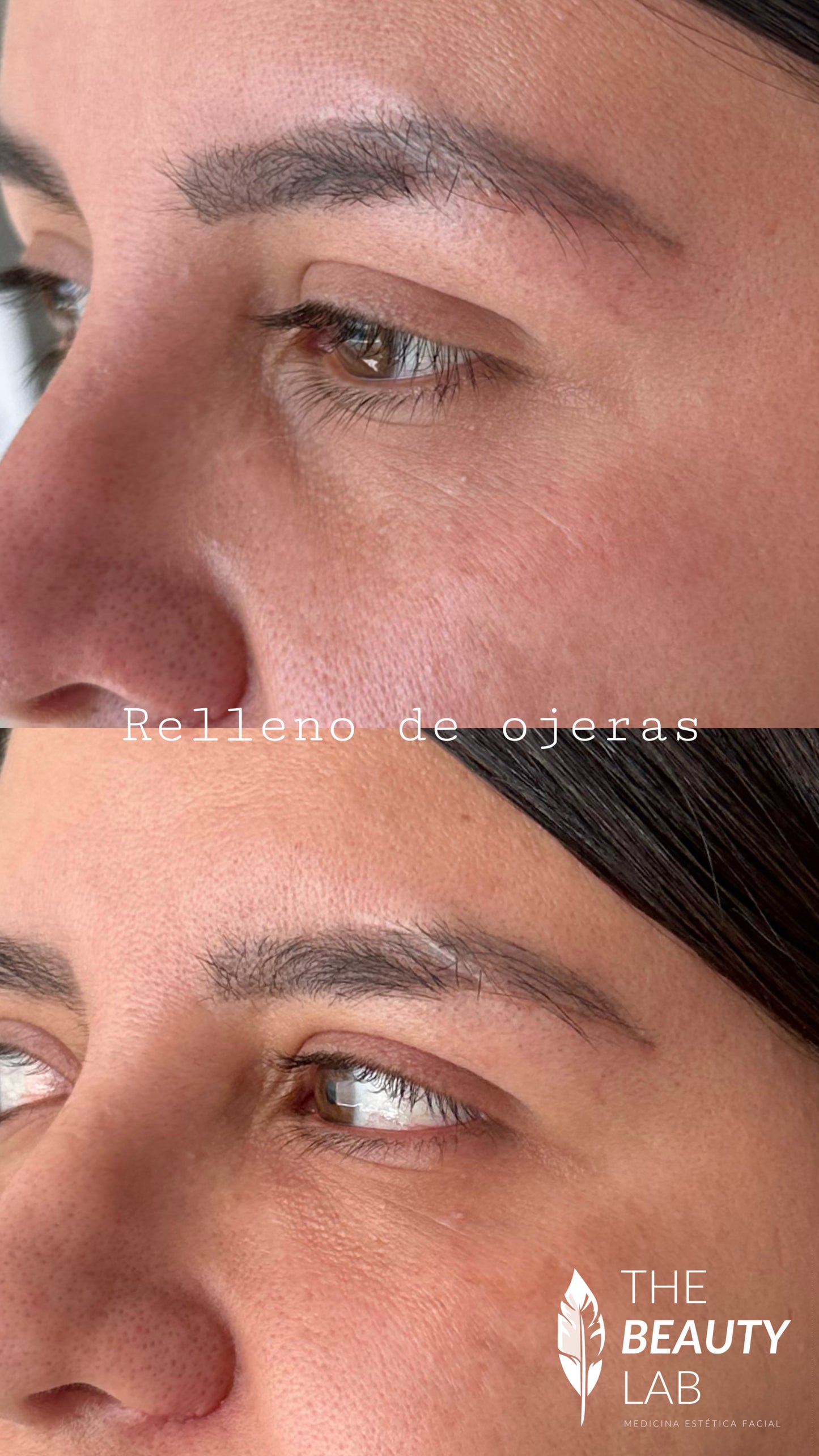 Ojeras con Ácido Hialurónico