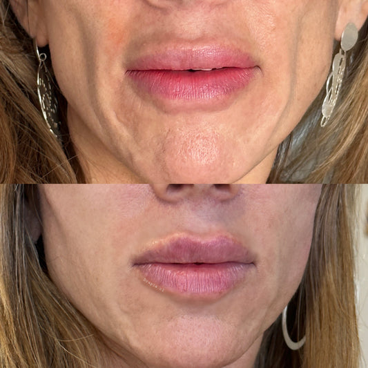 Sculptra® – Bioestimulación Avanzada de Colágeno