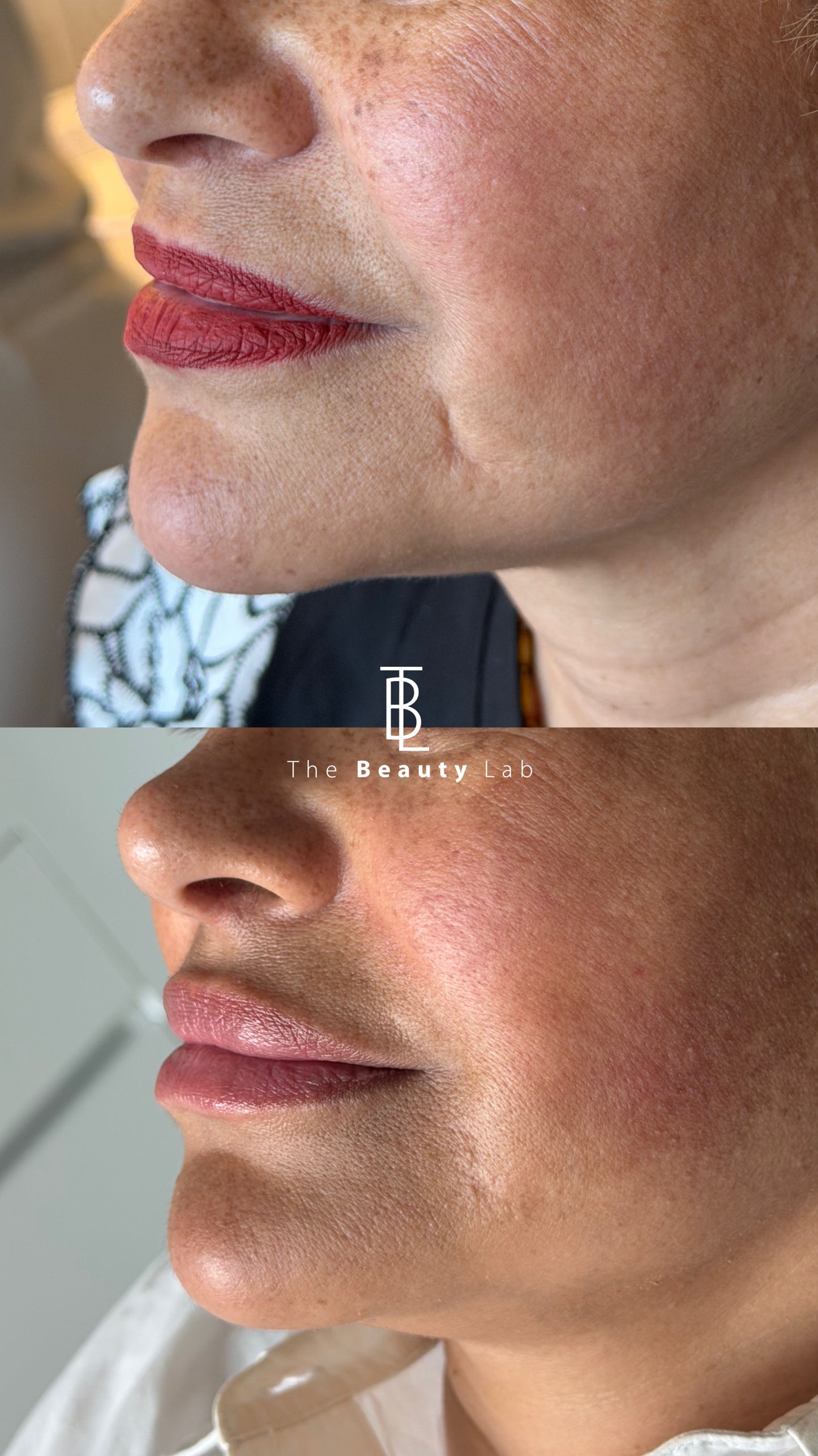 Skin Booster