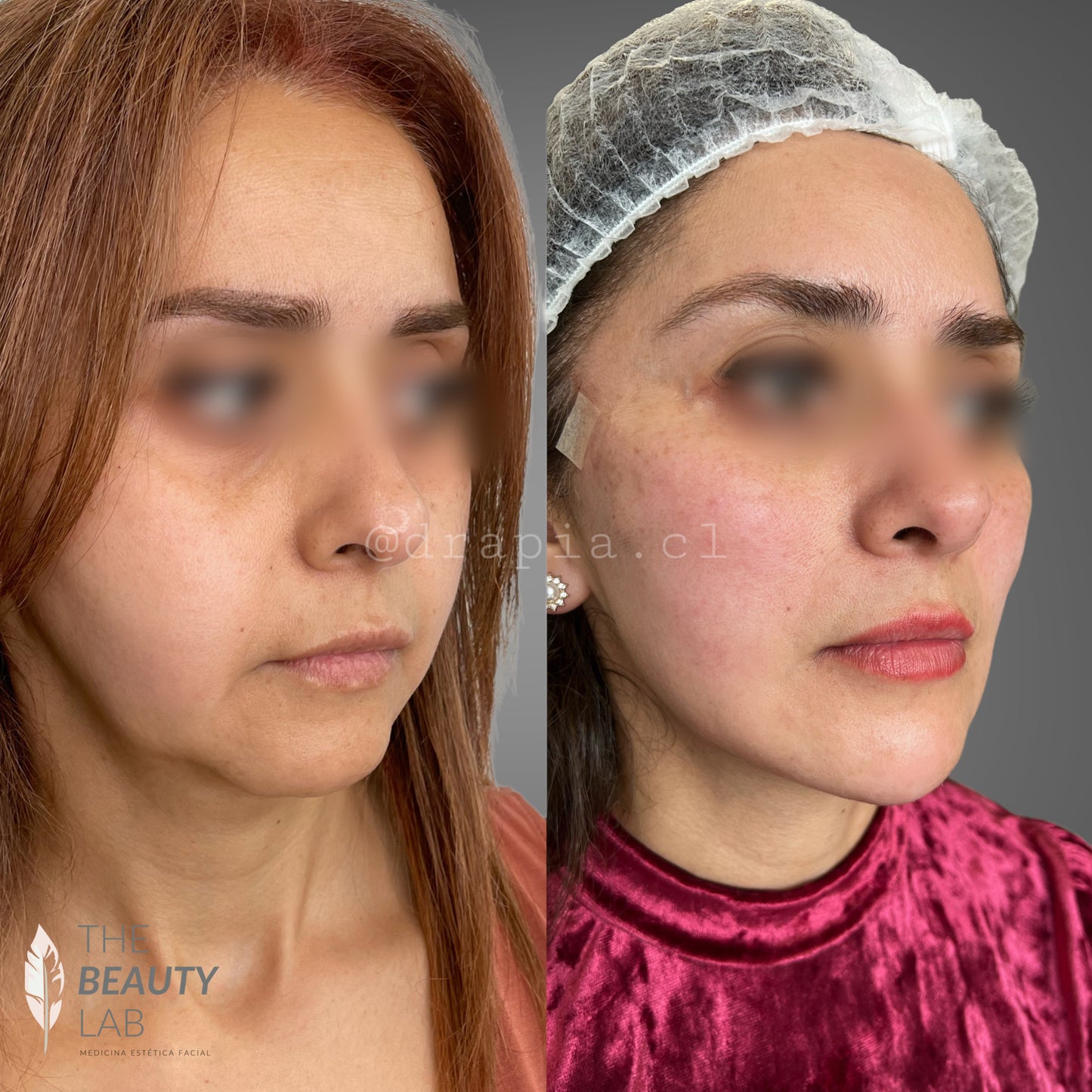 Radiesse® – Bioestimulación avanzada de colágeno