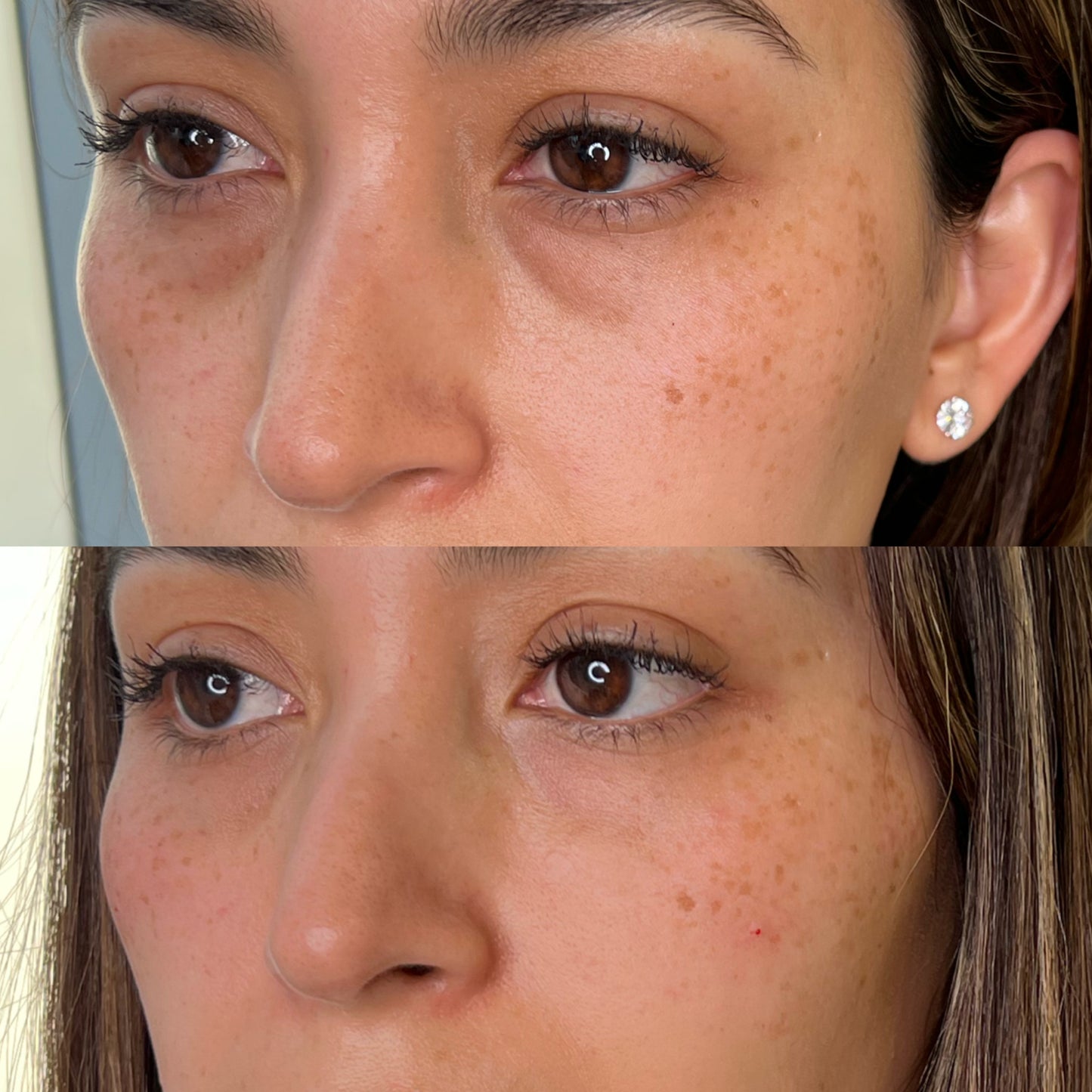Ojeras con Ácido Hialurónico
