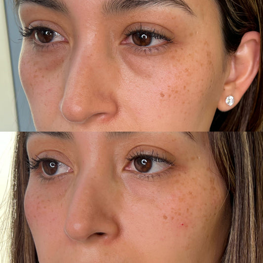 Ojeras con Ácido Hialurónico