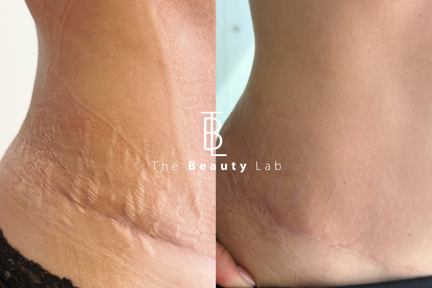 Tratamiento de estrias con laser Co2