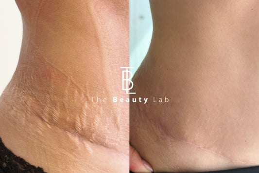 Tratamiento de estrias con laser Co2