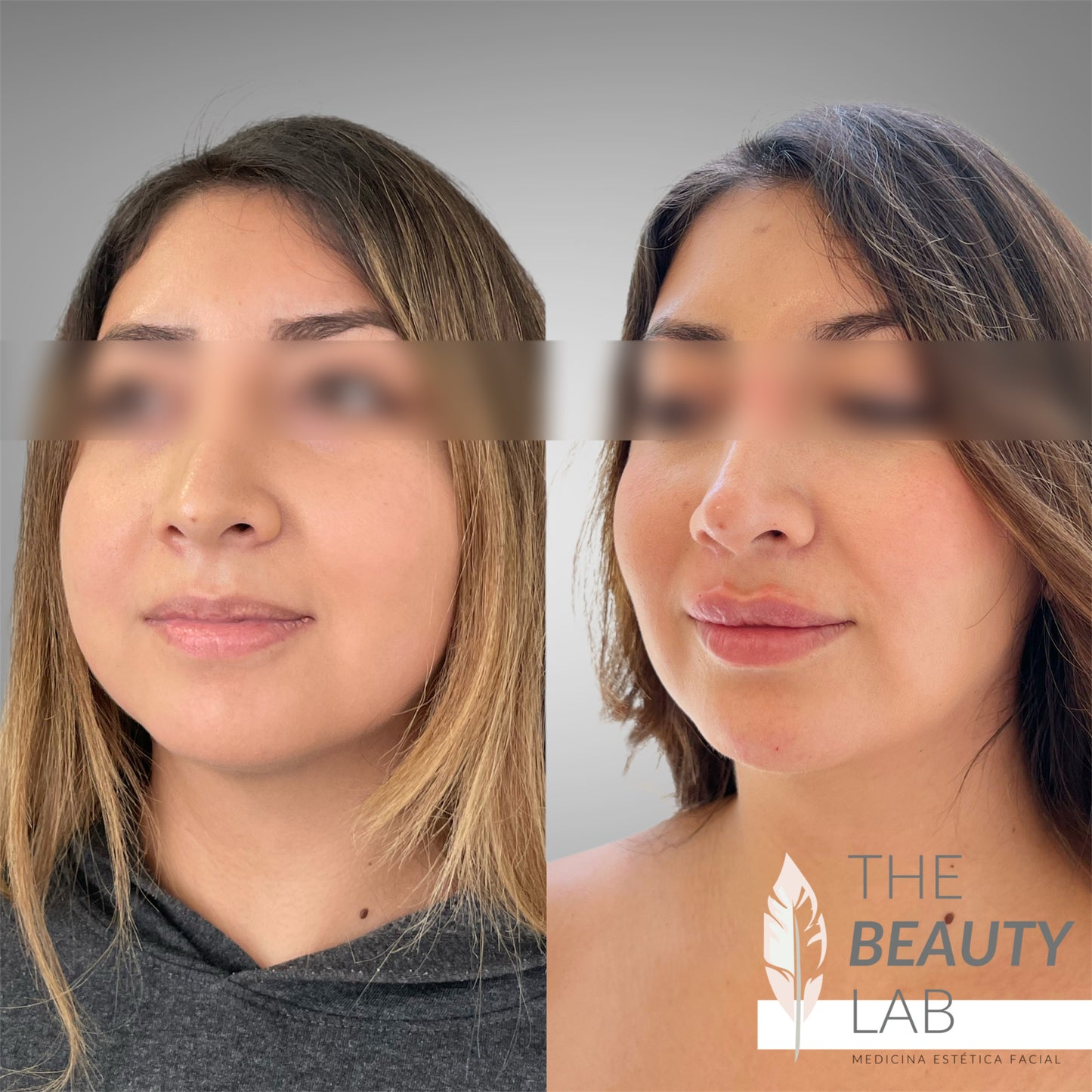 Bichectomía – Afinamiento del contorno facial