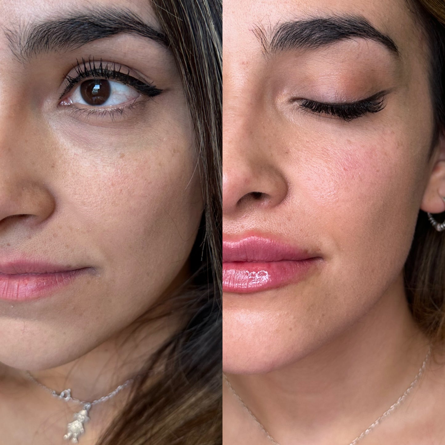 Aumento y definición de pómulos