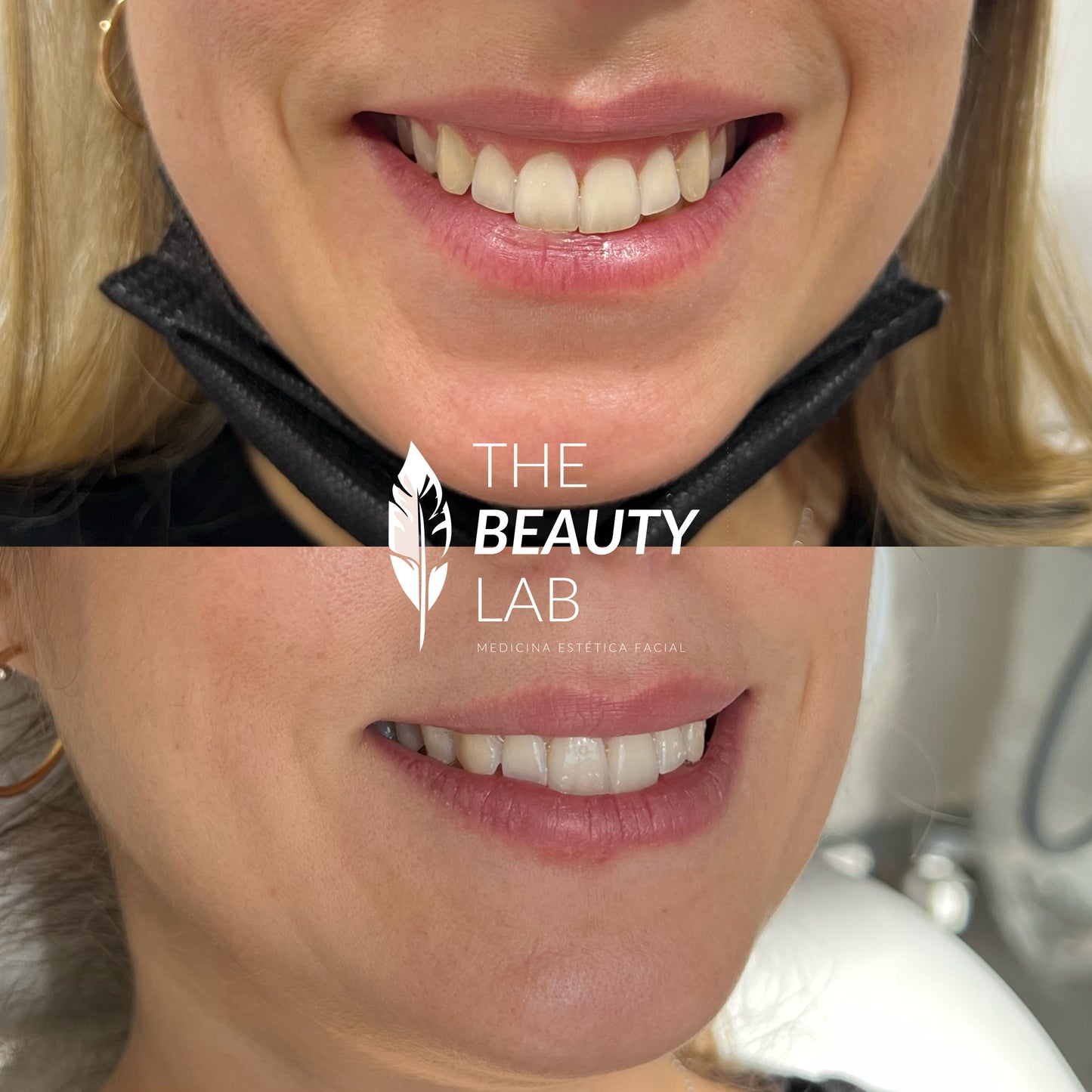 Corrección de Sonrisa Gingival con neuromodulador
