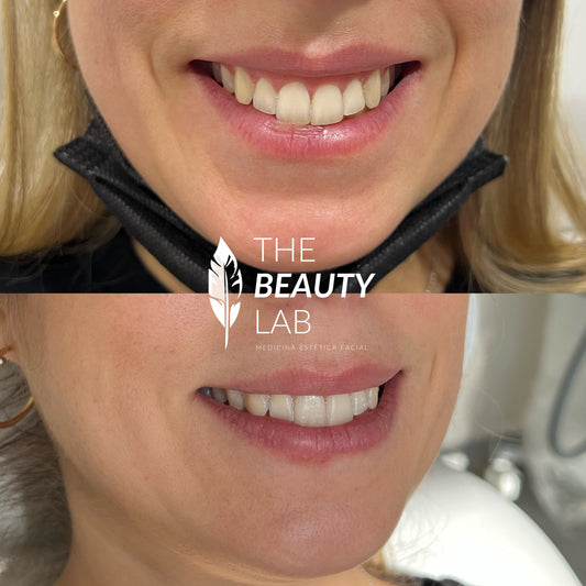 Corrección de Sonrisa Gingival con neuromodulador