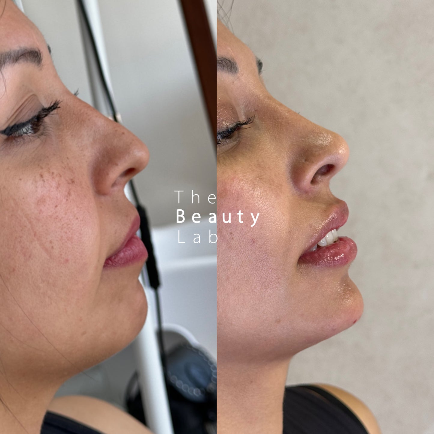 Perfiloplastia – Armonización del perfil facial