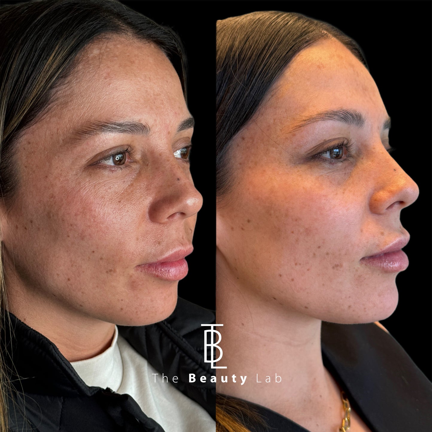 Láser ResurFX — Renovación profunda sin tiempo de inactividad