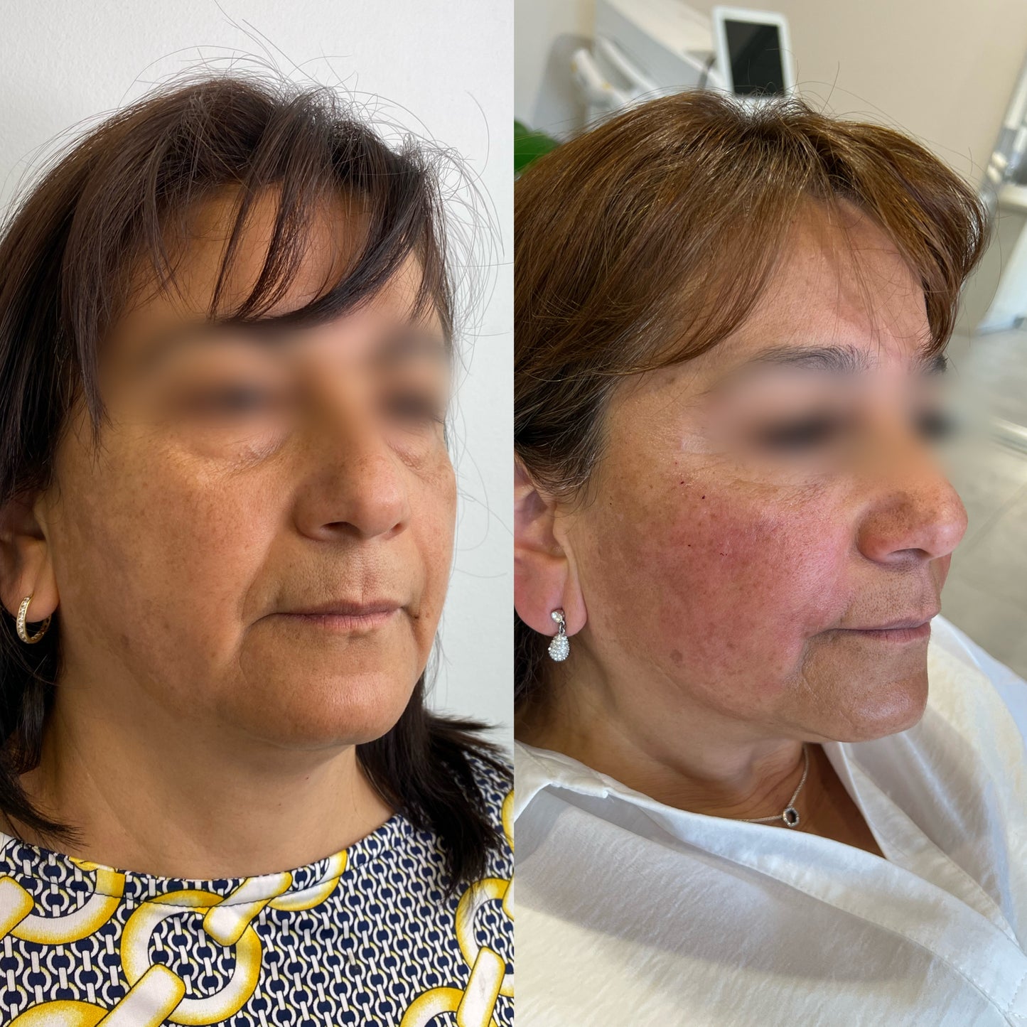 Radiesse® – Bioestimulación avanzada de colágeno