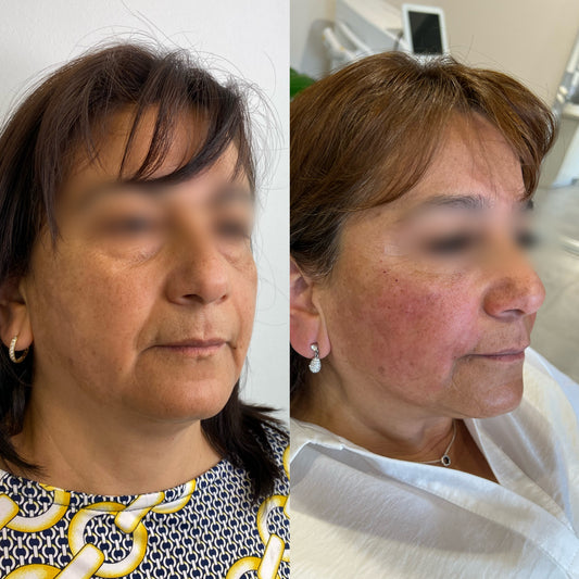 Radiesse® – Bioestimulación avanzada de colágeno
