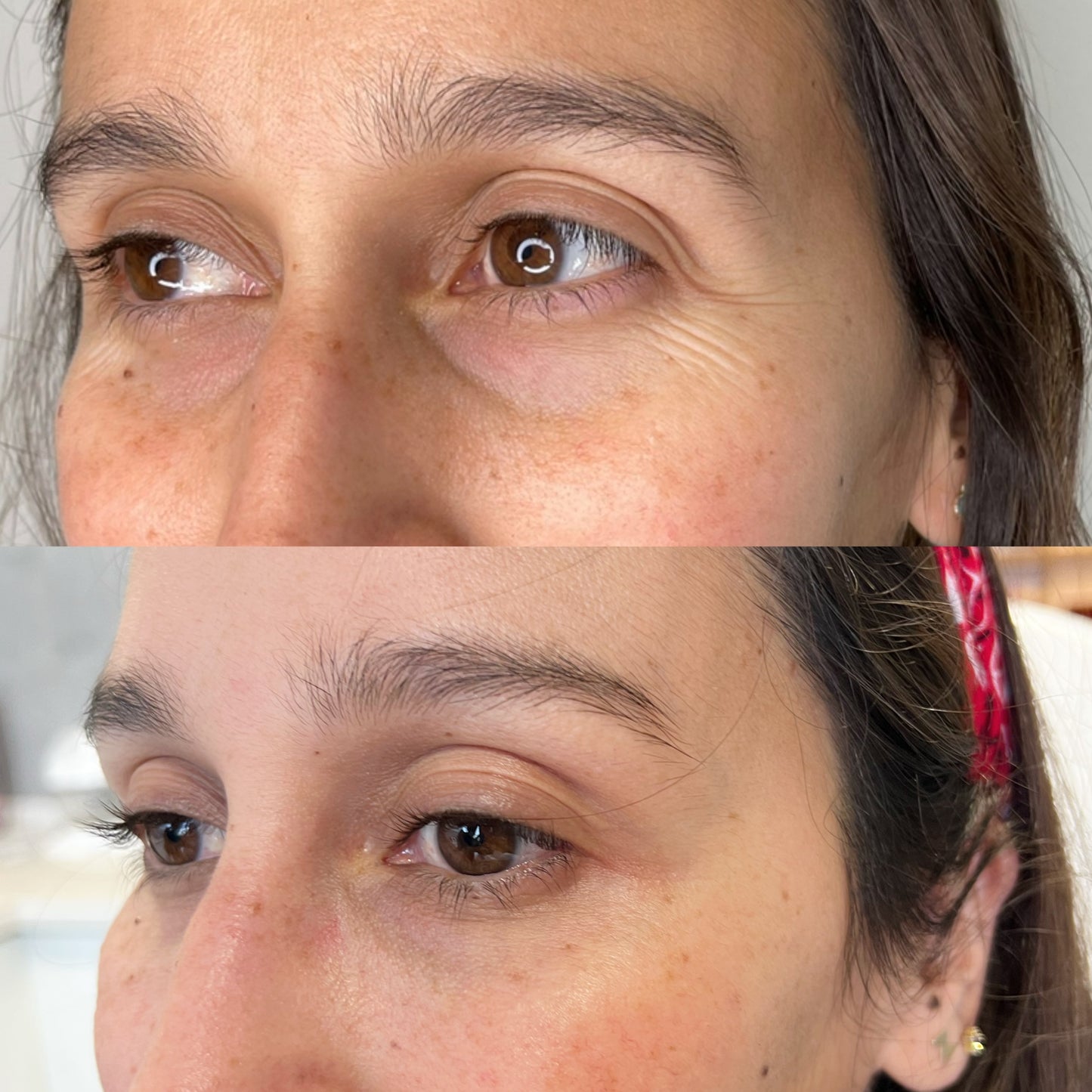 Ojeras con Ácido Hialurónico