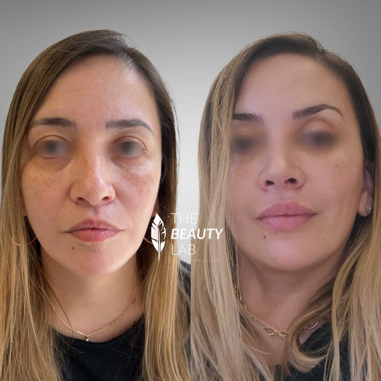 Rejuvenecimiento facial