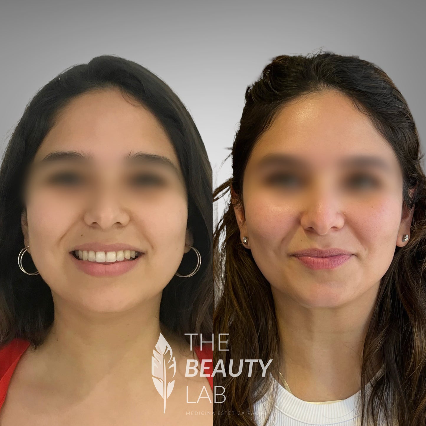 Bichectomía – Afinamiento del contorno facial