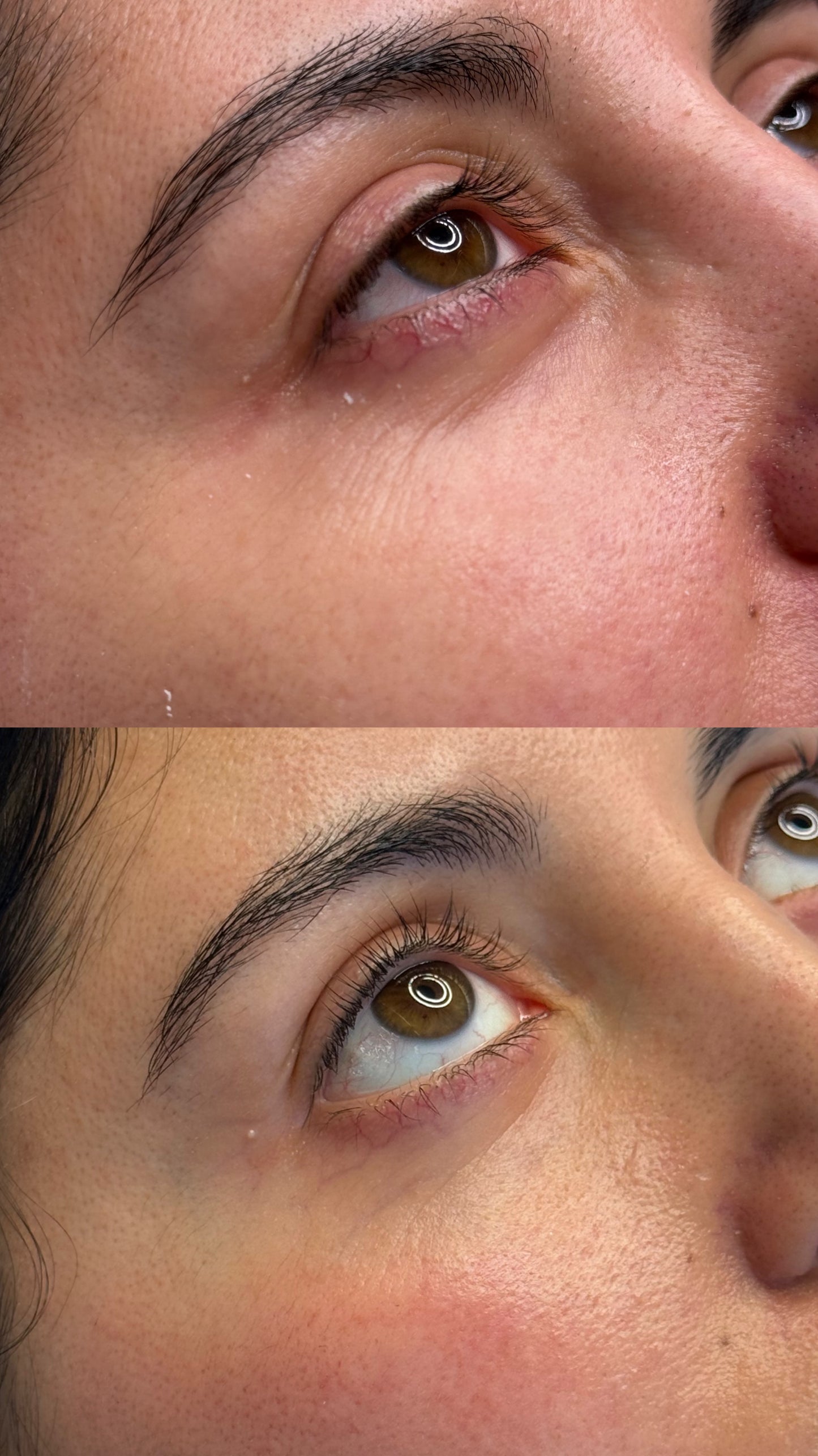 Rejuvenecimiento Periocular con Láser CO2 Tetra Pro de Deka (Italia)