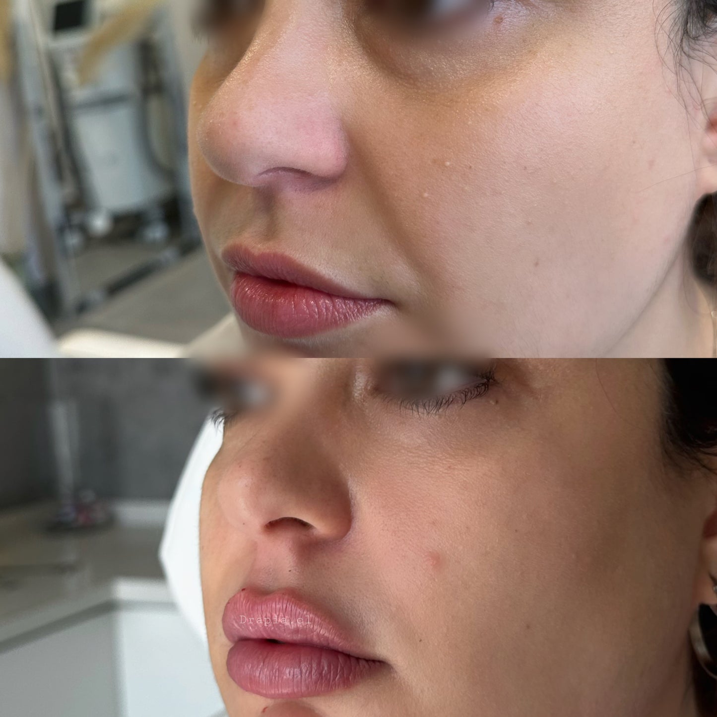 Aumento y definición de pómulos