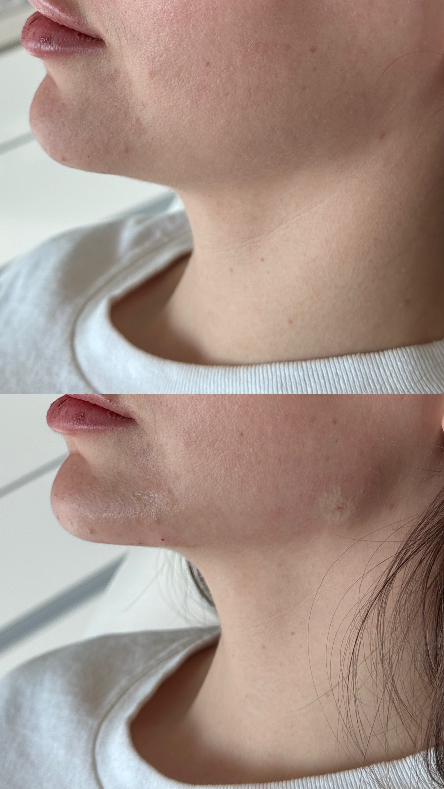 Radiesse® – Bioestimulación avanzada de colágeno