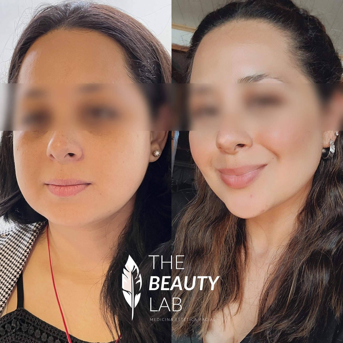 Bichectomía – Afinamiento del contorno facial