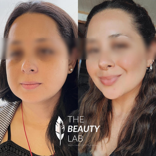 Bichectomía – Afinamiento del contorno facial