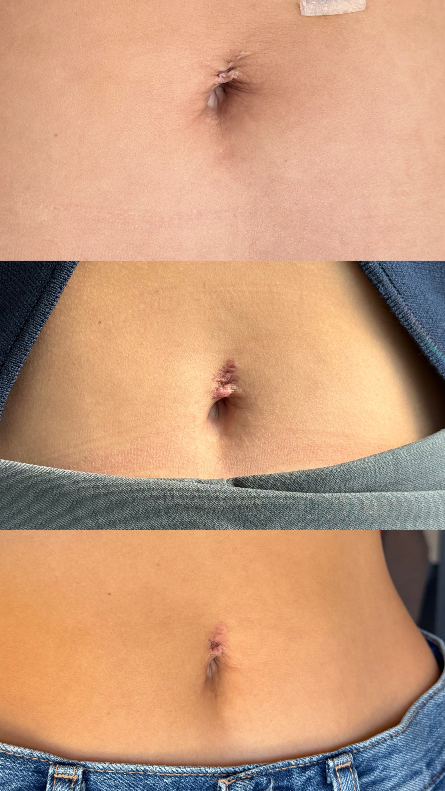 Post parto - Abdomen