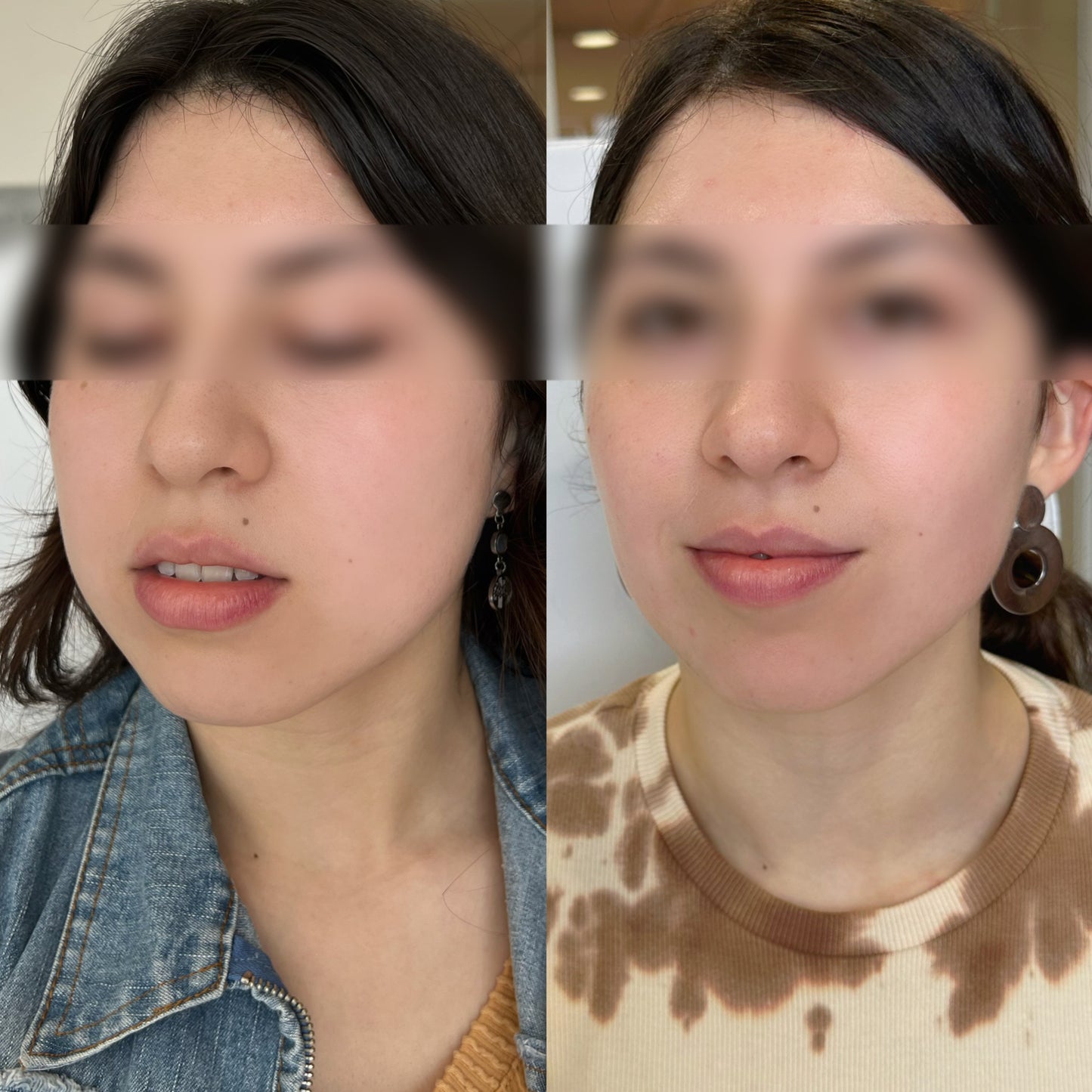 Bichectomía – Afinamiento del contorno facial