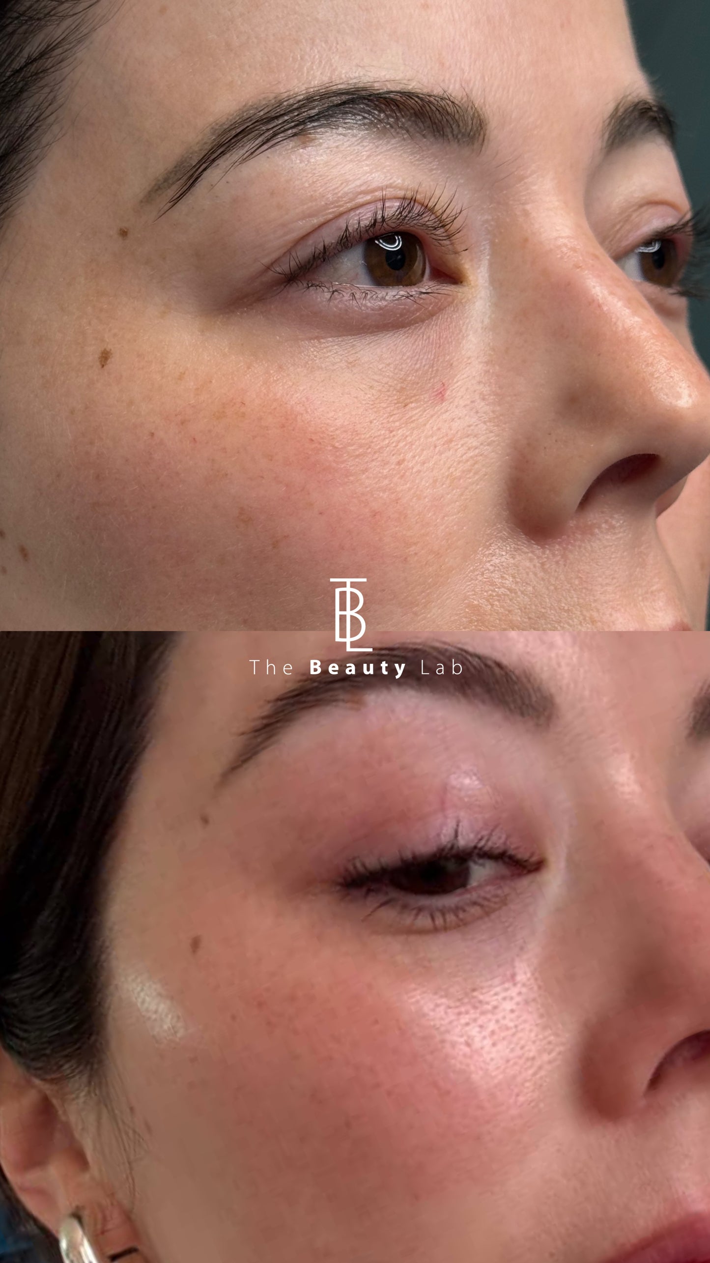 Rejuvenecimiento Periocular con Láser CO2 Tetra Pro de Deka (Italia)