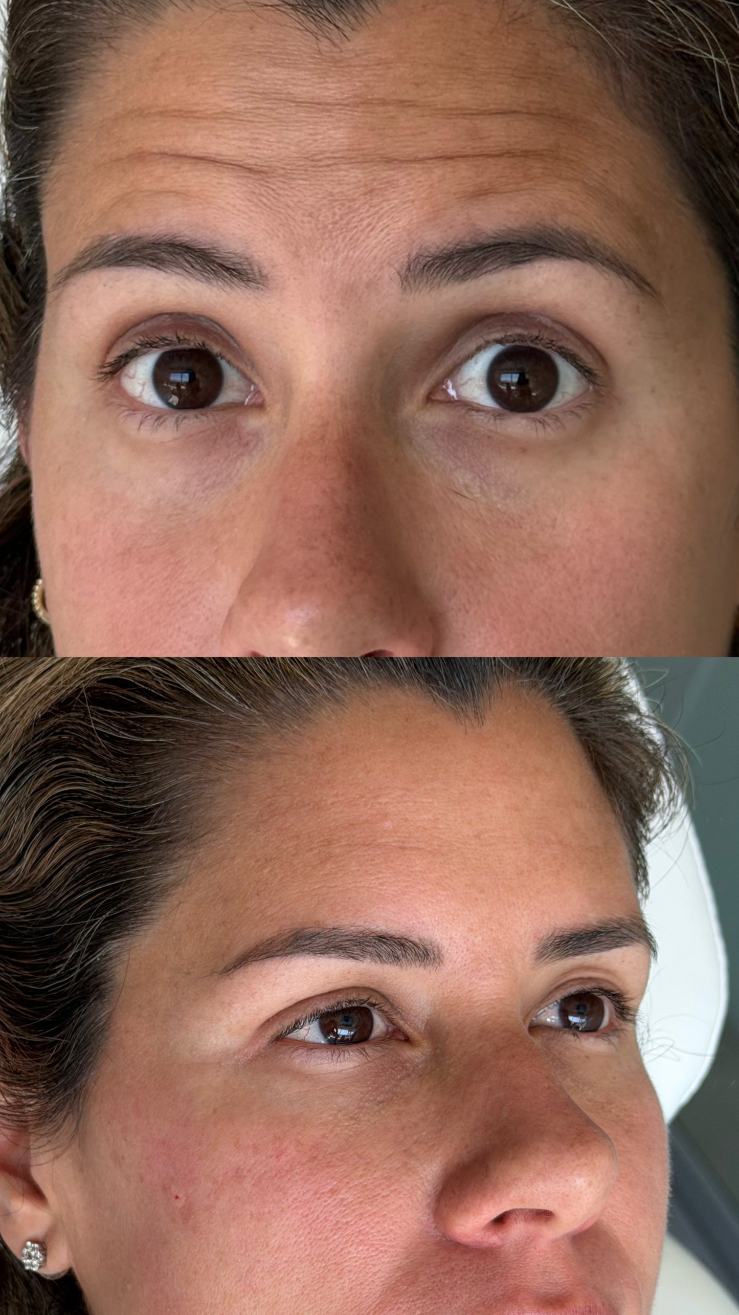 Relajante de Arrugas de Expresión