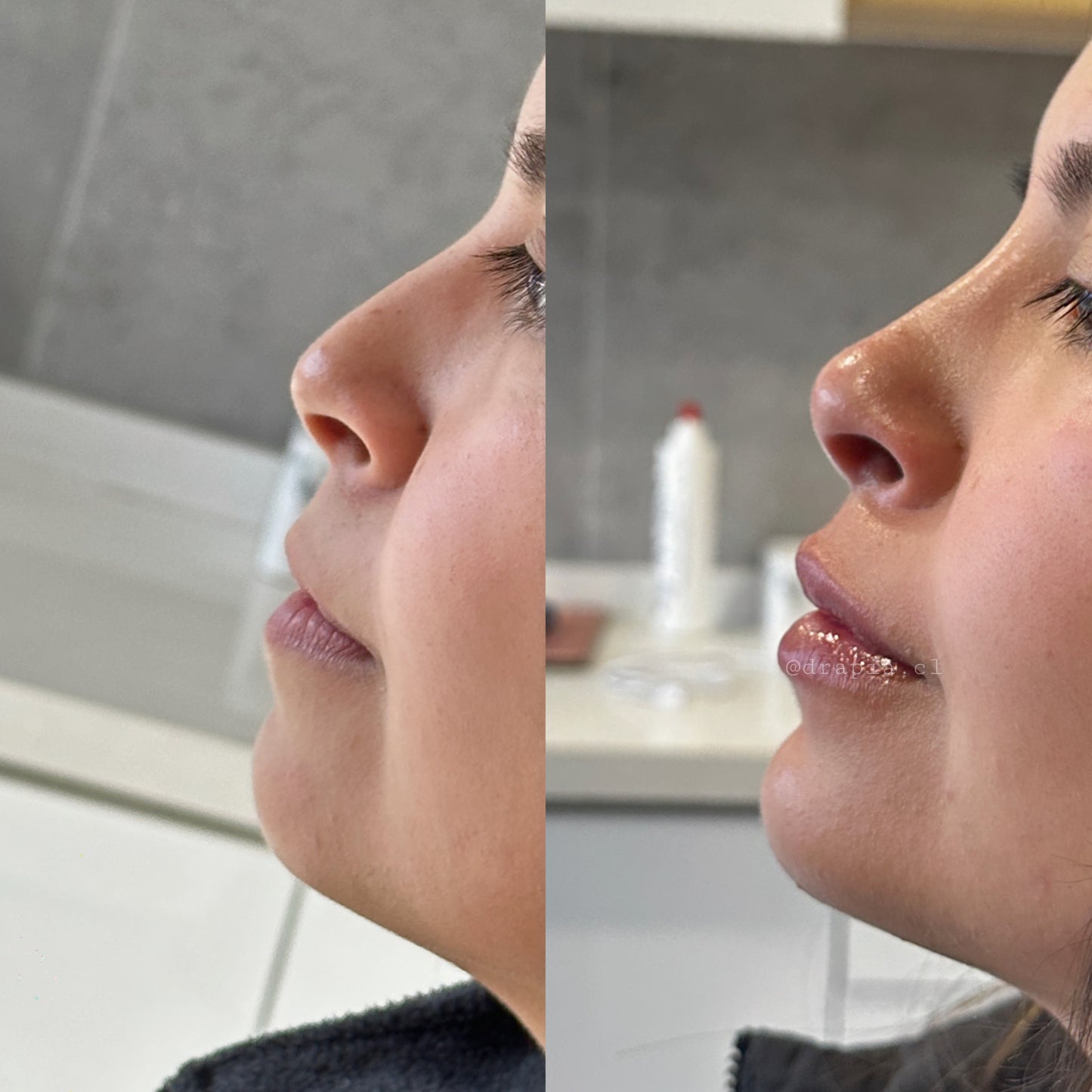 Perfiloplastia – Armonización del perfil facial