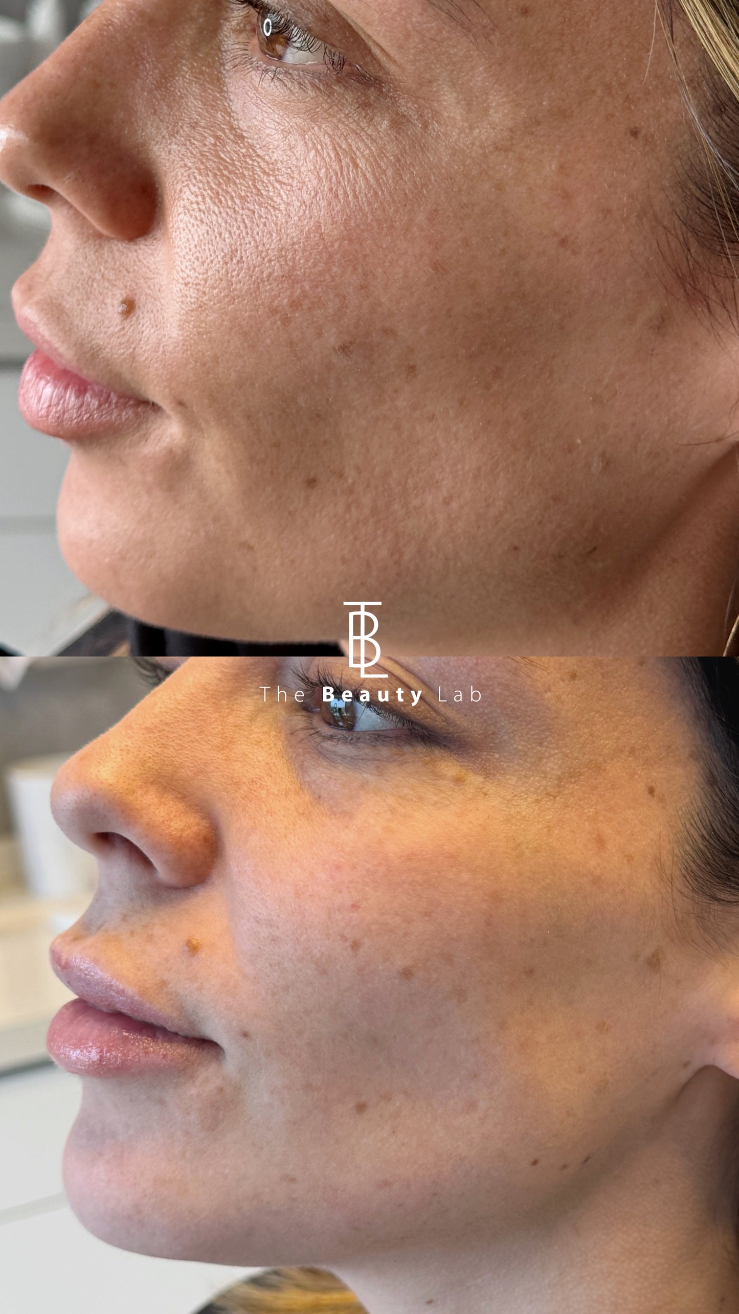 Láser ResurFX — Renovación profunda sin tiempo de inactividad