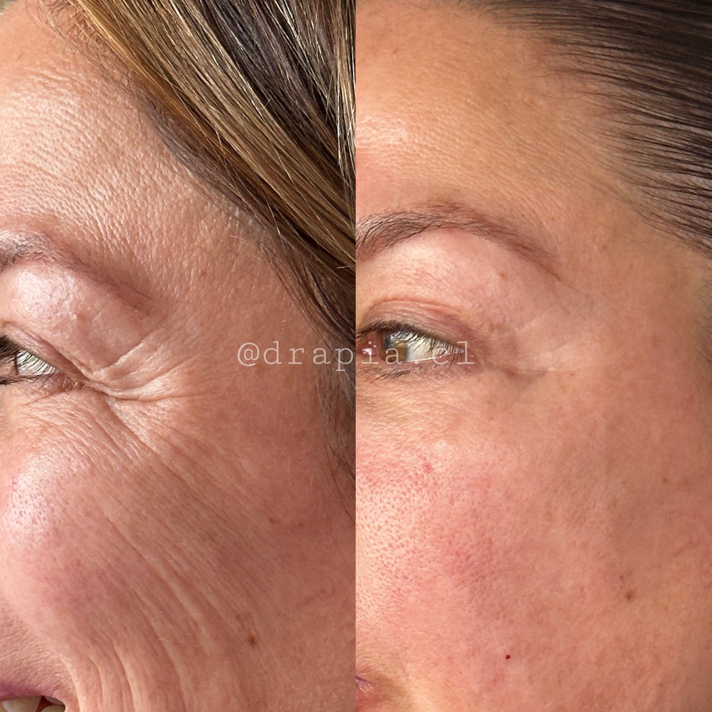 Relajante de Arrugas de Expresión