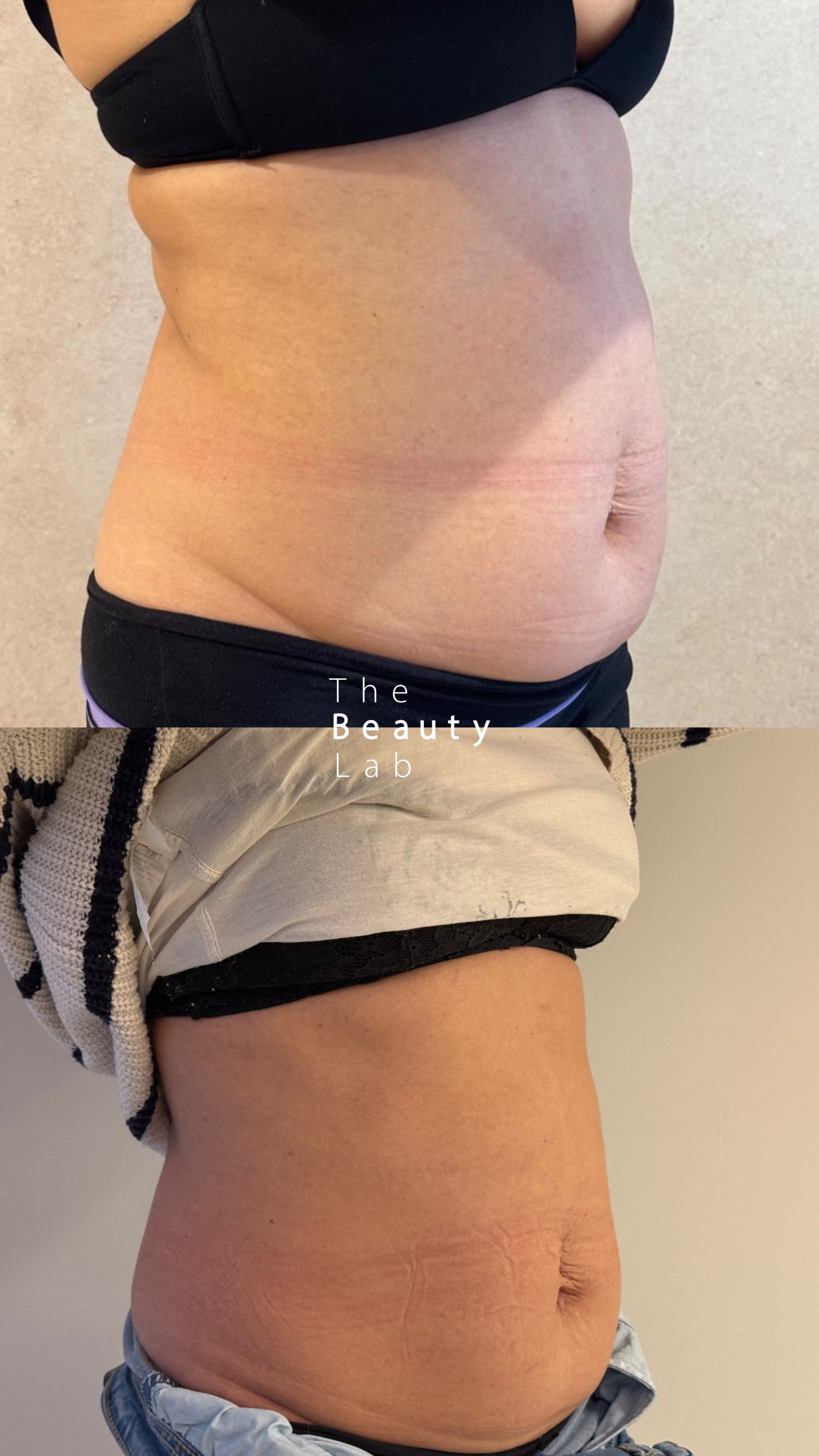 Post parto - Abdomen