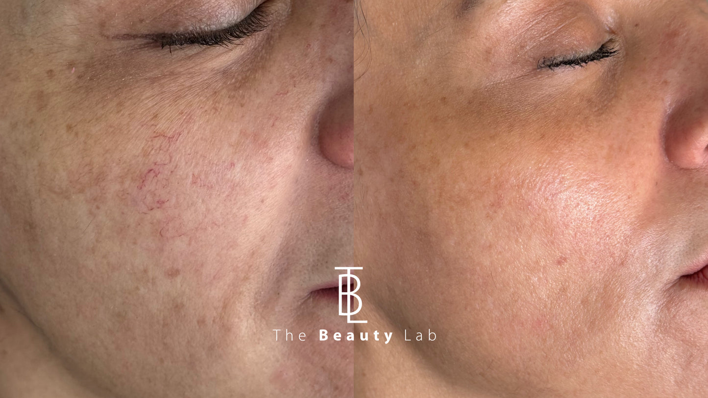 Plataforma Stellar M22/ IPL + NDYAG