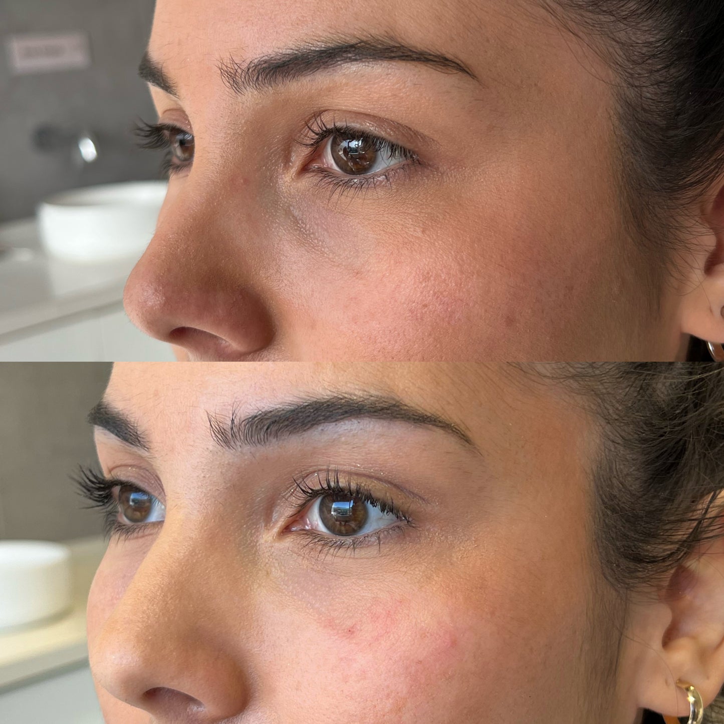Ojeras con Ácido Hialurónico