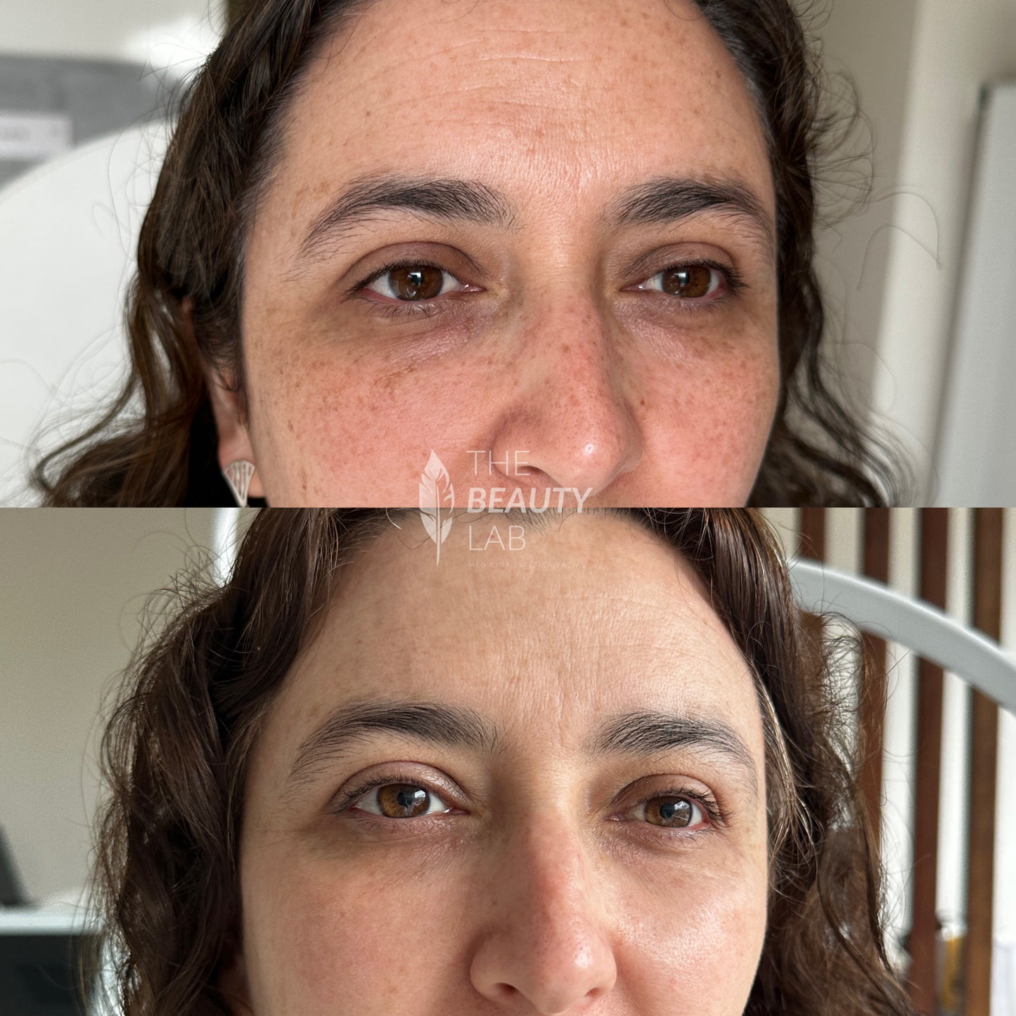 Ojeras con Ácido Hialurónico