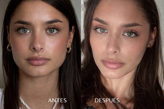 Toxina Boutulínica Bruxismo | Hipertrofia Maseterina