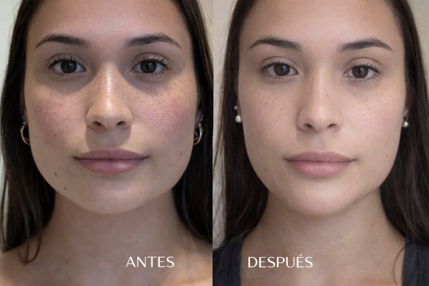 Toxina Boutulínica Bruxismo | Hipertrofia Maseterina