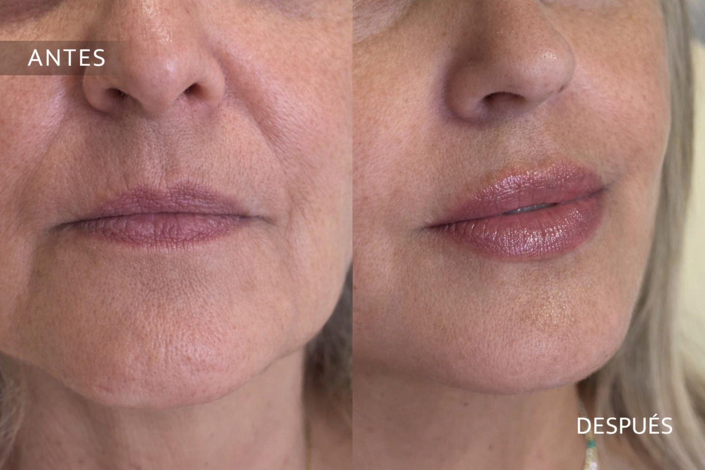 Labios lips by Dra Pia