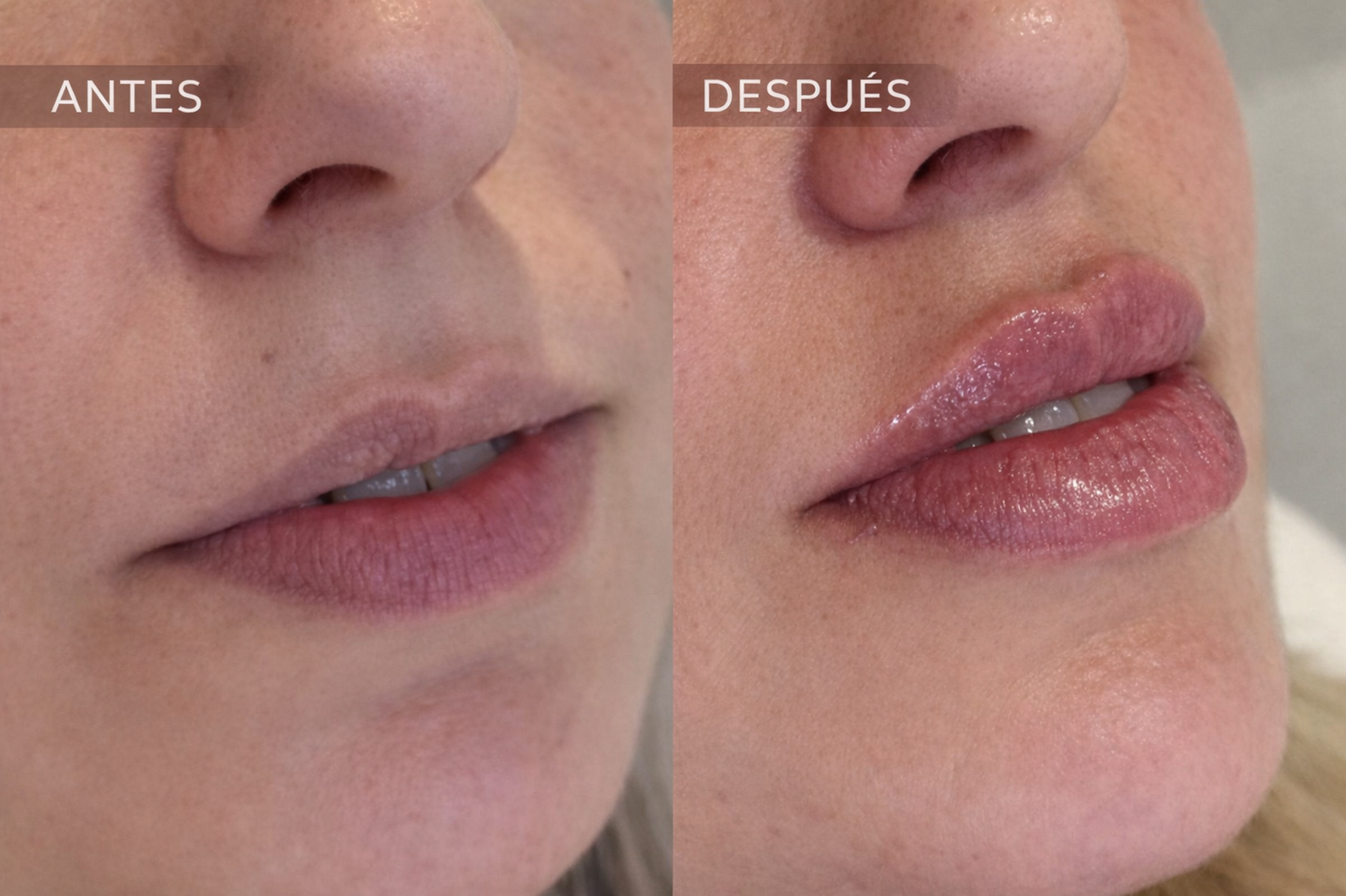Labios lips by Dra Pia