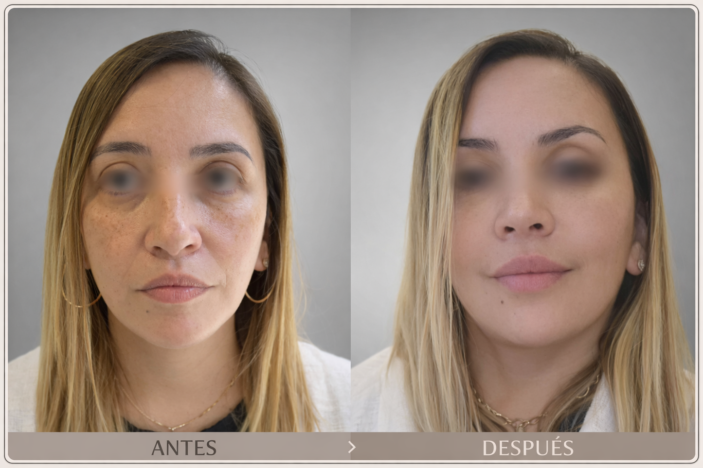 Rejuvenecimiento facial